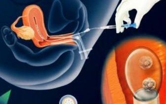 2026成都人工授精医院排名，满足这些条件才能做人授